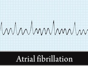 8 reasons that might be hampering your Afib care, reports ESC study