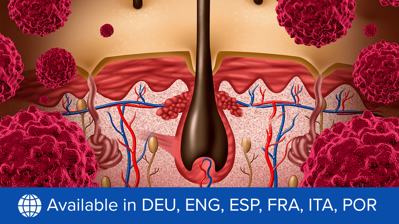 Improving Outcomes in Advanced Resectable CSCC: An Expert Viewpoint on ...