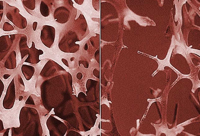 photo of Osteoporosis