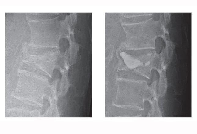photo of spinal compression fractures