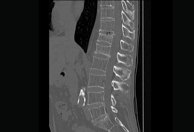 photo of osteoporosis of the spine