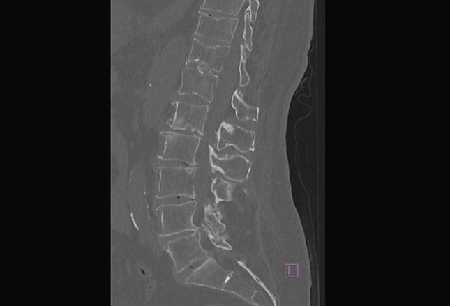 Diashow: Osteoporose rasch erkennen und gezielt behandeln