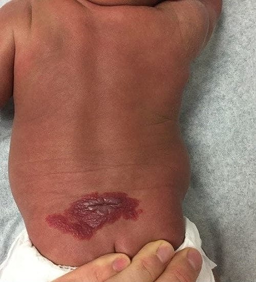 Enlarging Midline Lumbar Lesion and Dermal Pit in a Newborn