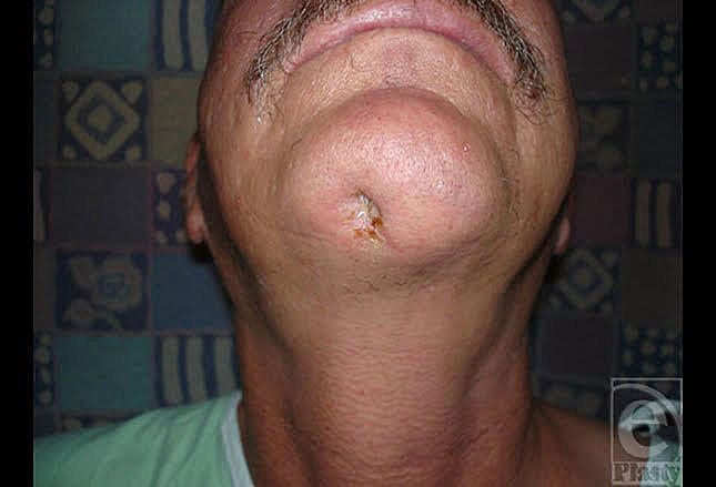 tobacco on spider bite Brown recluse led to leg being amputated, woman says Tobacco Industry Deceit | Black