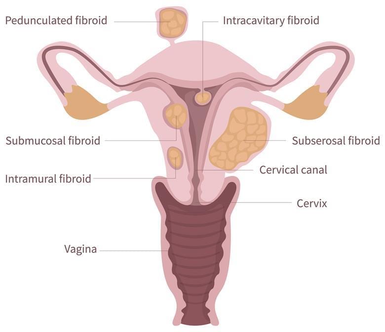 Positioning of different types of uterine fibroid