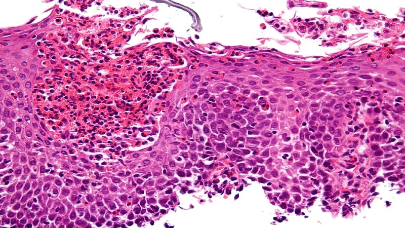 Mejorar los protocolos endoscópicos para evitar el subdiagnóstico de la esofagitis eosinofílica en México