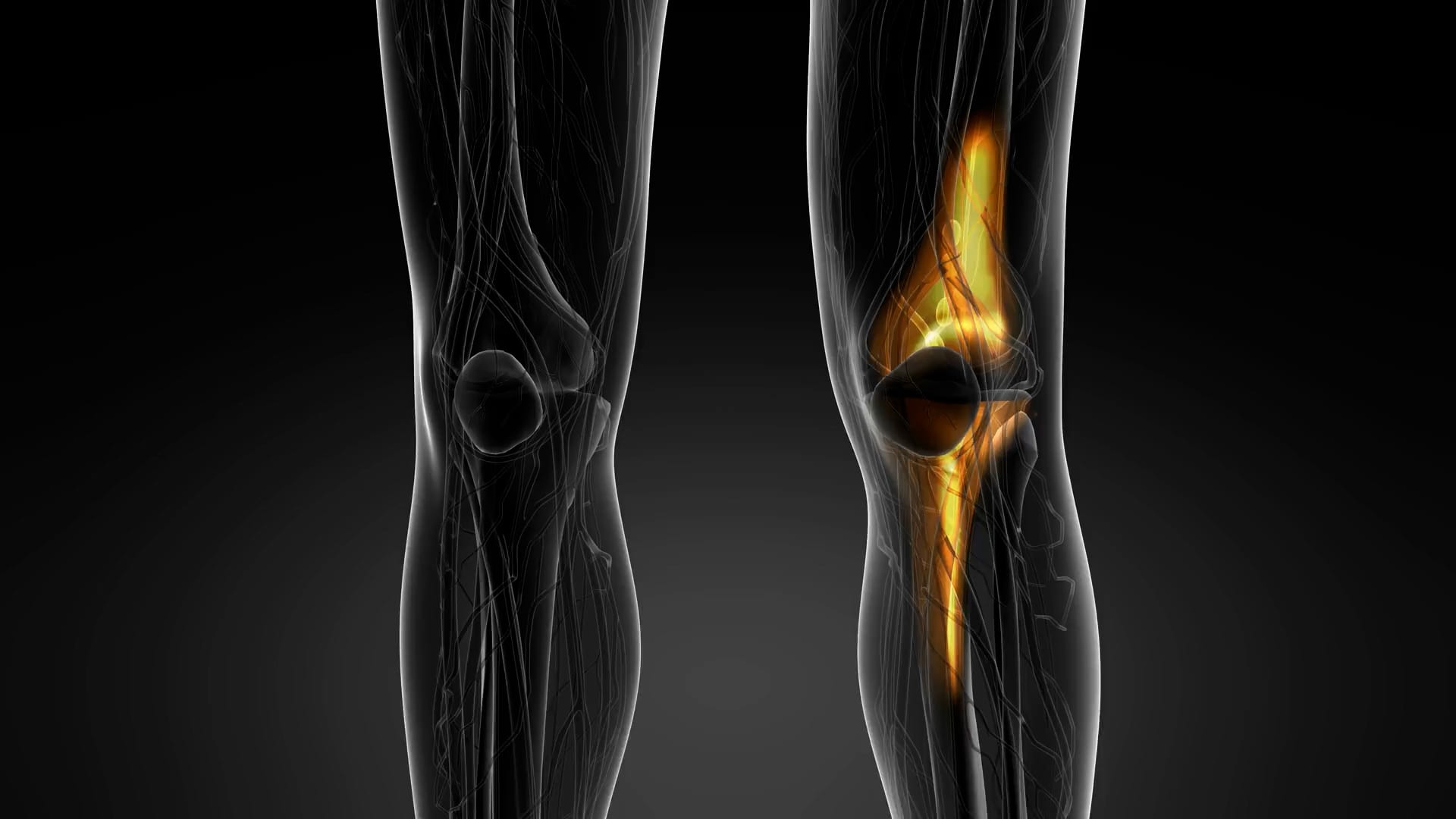 Study Links Calcium Crystals to Future Knee OA
