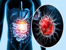 photo of Colon cancer