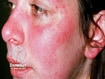 photo of Cutaneous lupus erythematosus