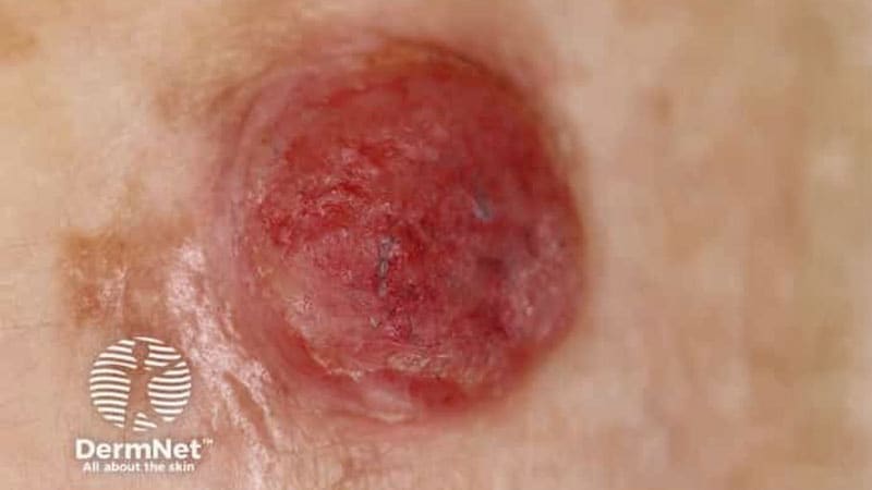 Amelanotic Melanoma Tied to Worse Survival