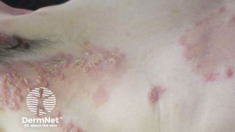 Caso clínico: Exantema en una paciente con enfermedad de Crohn