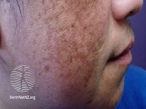 Facial Melasma Improves With New Cosmeceutical