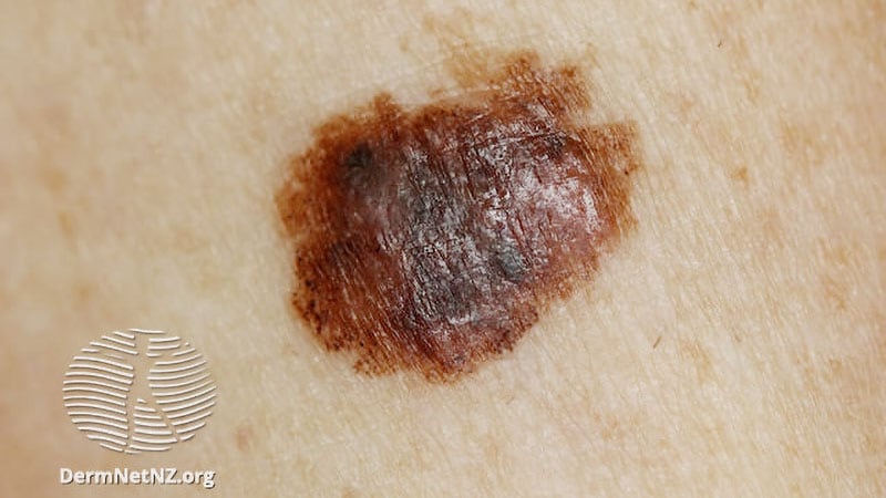 Medicare IHC Claims With Melanoma Dxs Increased, Study Finds