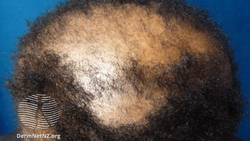 Réponses majeures observées en cas de perte de cheveux cicatricielle et totale
