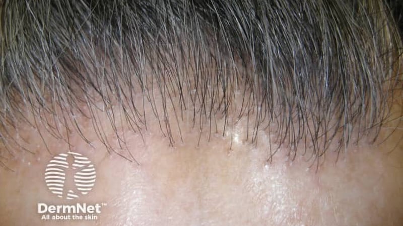 Topical JAKi Shows Promise for Frontal Fibrosing Alopecia