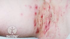 allodynia from glp 1 I've developed allodynia related to my GLP-1 medication. Any minor skin  “injury” (repeated friction) causes painful skin for hours. The best way to  manage it is to prevent irritation so here I