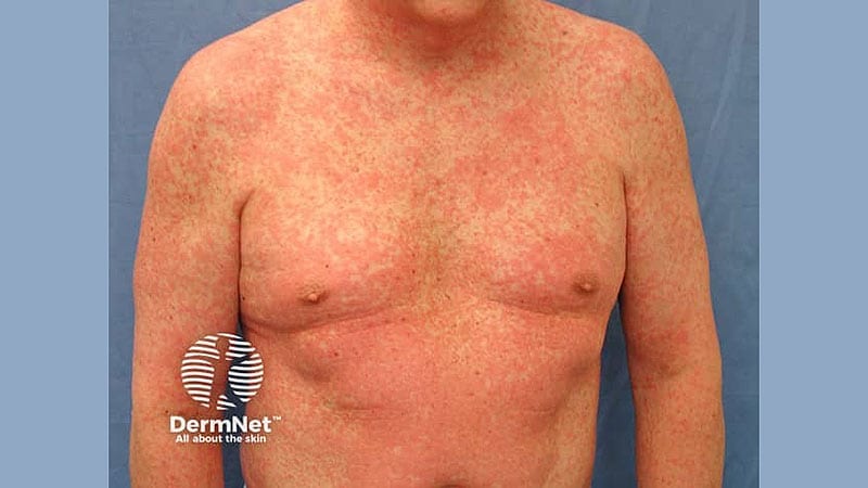 IL-5 Inhibitors May Be Steroid Alternative For Rx of DRESS