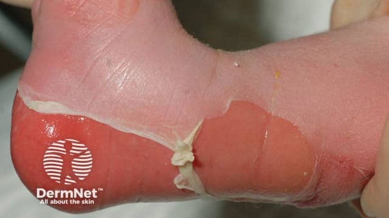 FDA Approves First One-Time Treatment for RDEB Wounds