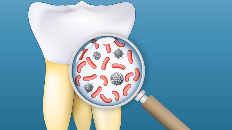Oral Health a Neglected Stroke Risk Factor?