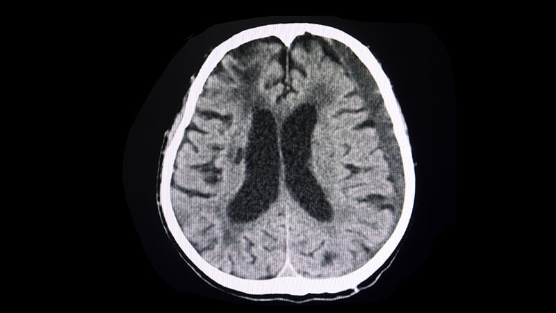 Aspirin Continuation vs Discontinuation in Brain Surgery