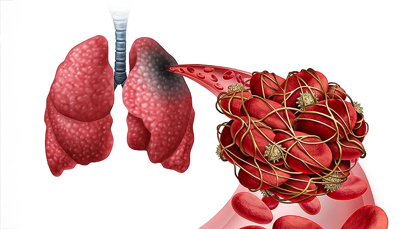 You Can Manage Pulmonary Embolism in Primary Care