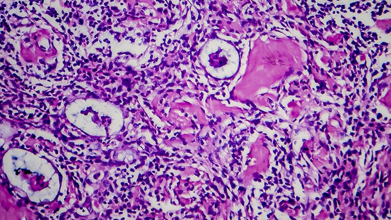 HL: Second-Line Sintilimab Plus Chemo Bests Chemo Alone