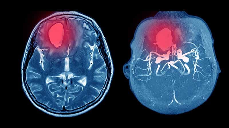 APOE4 May Raise Brain Bleed Risk in Apixaban Users With AF