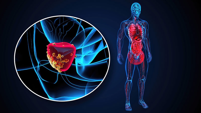 Pluvicto in First-line Hormone-Sensitive Prostate Cancer?