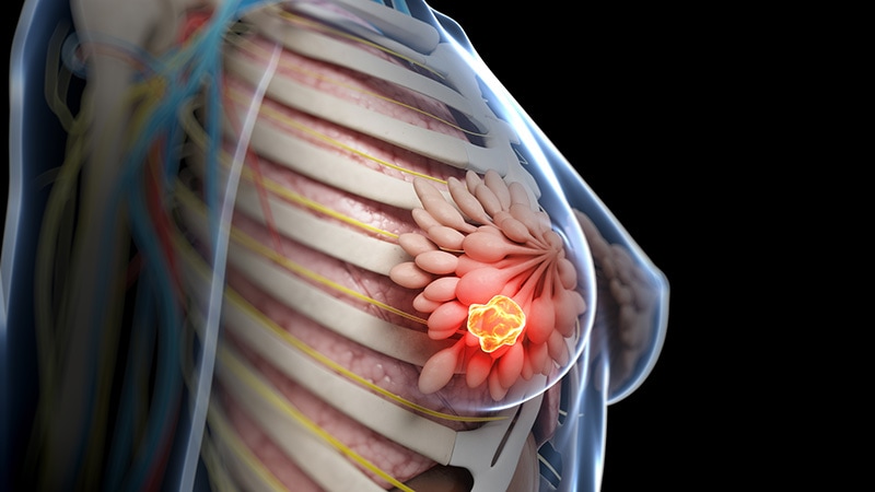 Cancer du sein à haut risque : l'abémaciclib augmente la survie globale
