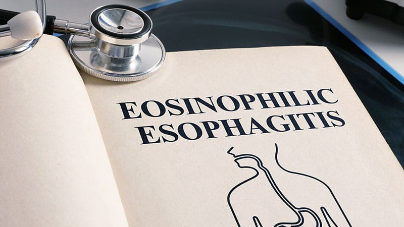 Higher Rates of EOE, Food Allergy Mostly in White Male Teens