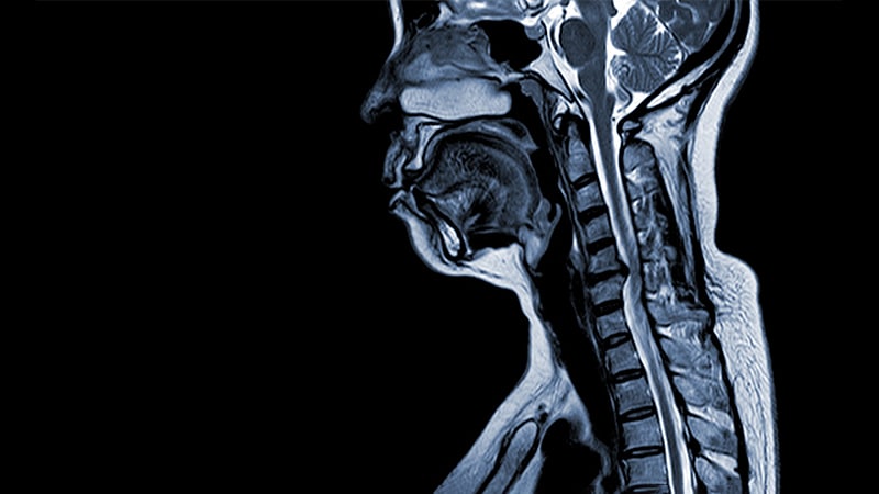 Airway Obstruction From Warfarin Induces Haematomas in a Man