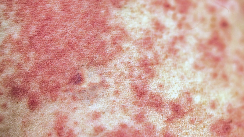 Dermatologic Emergencies Clinicians Must Not Miss