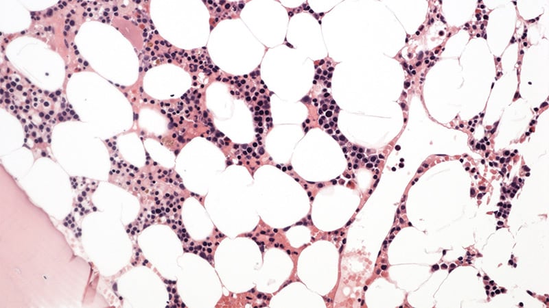 Rapid Review Quiz: InFocus PNH