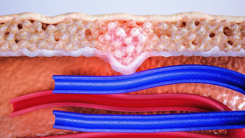 Giredestrant for Early Breast Cancer: Where Will It Fit In?