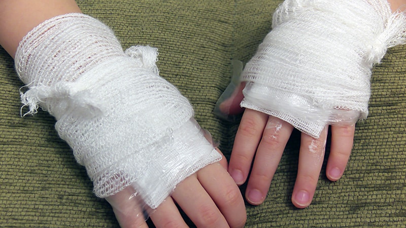 Nach Crans-Montana: Wie Ärzte Patienten mit schweren Brandverletzungen versorgen