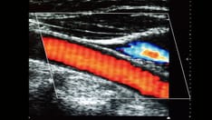 Managing Asymptomatic Carotid Stenosis in 2026