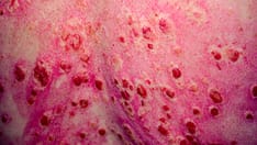 Study: SIGLEC-1 Tracks Lupus Response to Anifrolumab