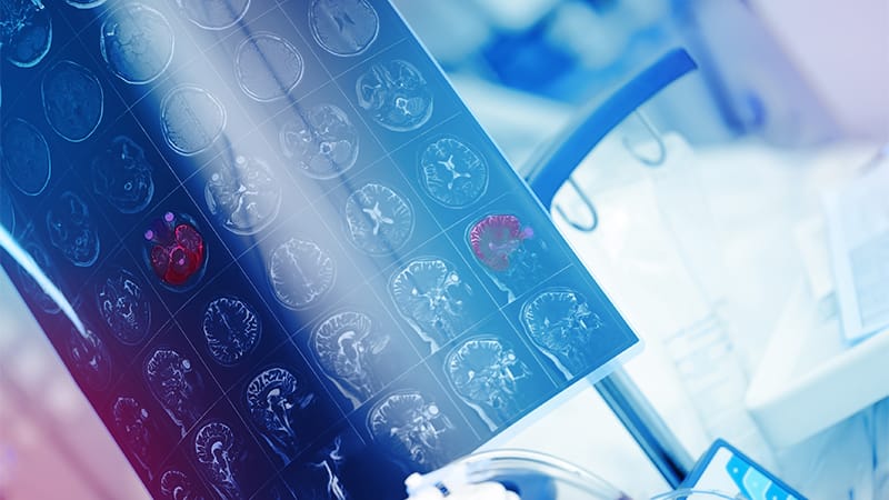 Cenobamate Outperforms Other ASMs for Focal Epilepsy