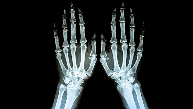 Joint Patterns Predict Treatment Response in Early RA