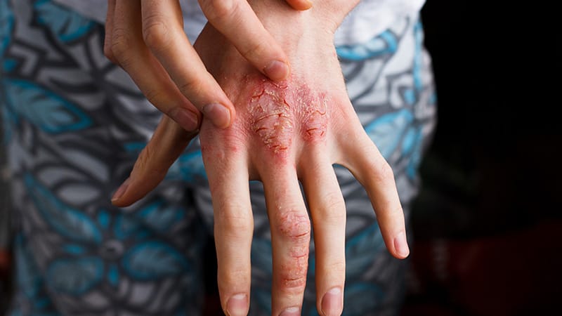 Eczema and the Topical Steroid Withdrawal Controversy
