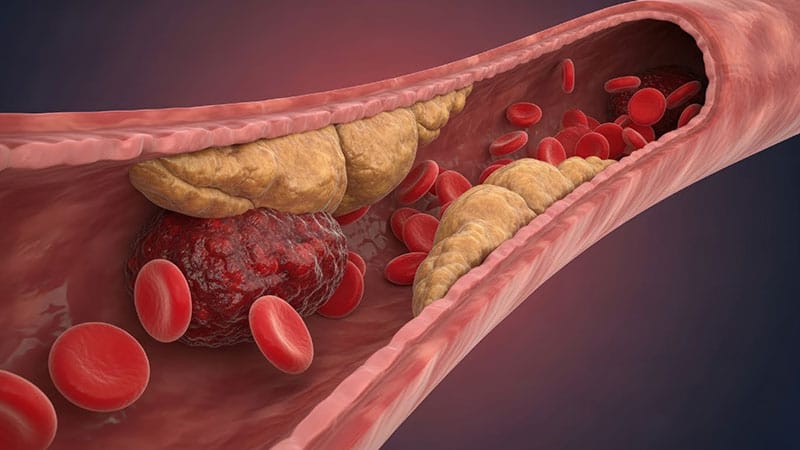 Thrombectomy Shows Late Benefit in Large-Core Stroke: TESLA