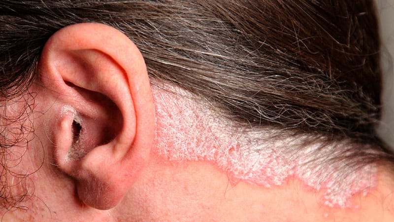 Biologics Continue to Transform Psoriasis Care, Giving Physicians and Patients More Options