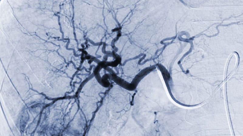 Immunotherapy Plus TACE Improves PFS in Unresectable HCC