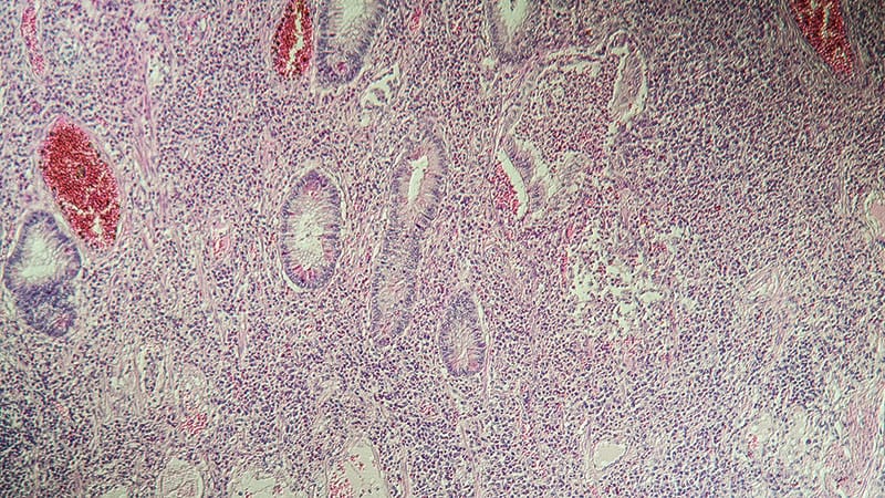 Fact or Fiction: Crohn's Disease - Medscape Reference