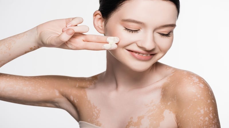 Teste Rápido: Extensão da doença e metas terapêuticas no vitiligo