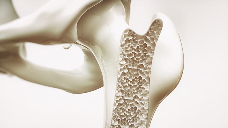 Medicare to Cover New Osteoporosis Diagnostic Screening Test