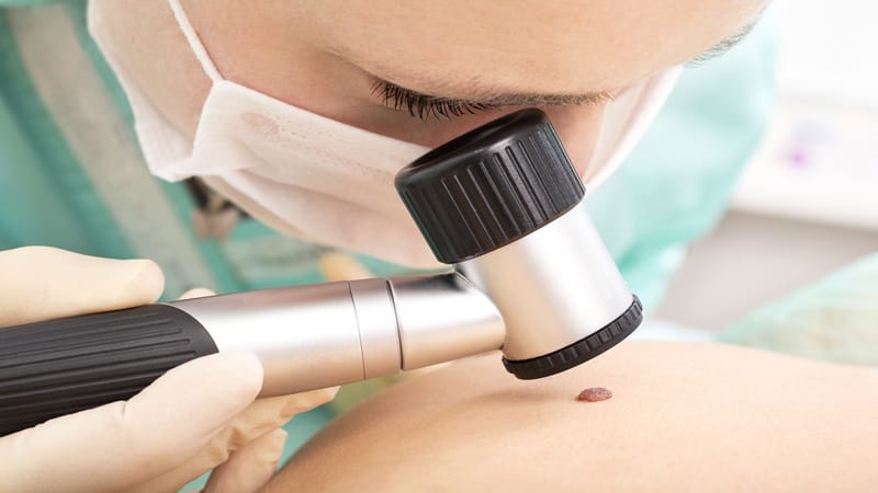 Teste Rápido: Estratificação de risco e tratamentos não cirúrgicos no carcinoma basocelular