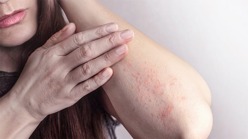 Which Factors Mediate Impact of Disease Severity on Quality of Life in Pruritic Dermatoses?