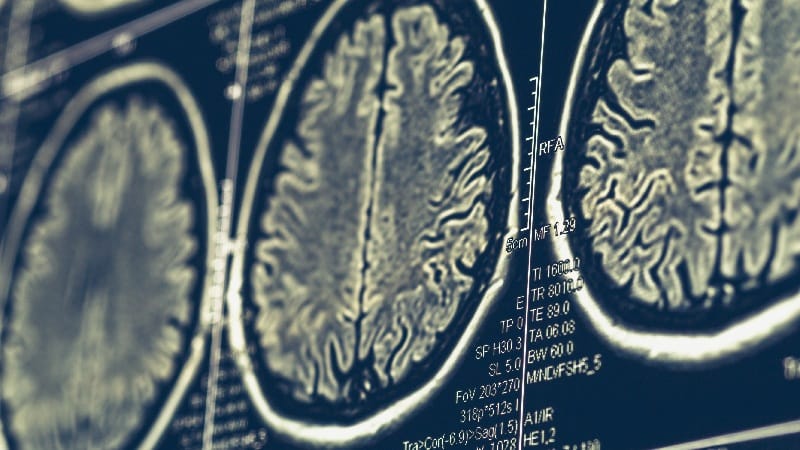 Cortical Atrophy Signals Progression in Early-Onset AD