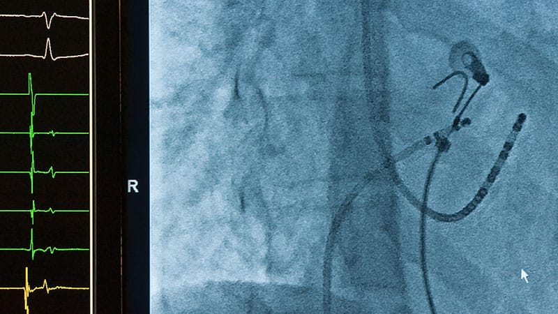 Does AF Ablation Work? That’s in Question After PVI-SHAM-AF - Medscape